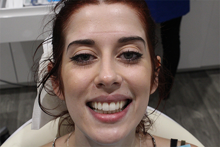 After Smile Makeover Treatment Reading Smiles After Smile Makeover Treatment Reading Smiles
