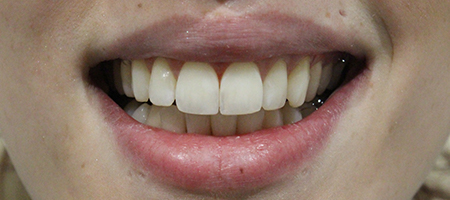 After Smile Makeover Treatment Reading Smiles After Smile Makeover Treatment Reading Smiles