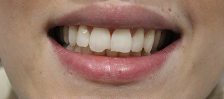 Before Smile Makeover Treatment Reading Smiles Before Smile Makeover Treatment Reading Smiles