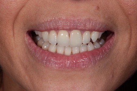 After Smile Makeover Treatment Reading Smiles After Smile Makeover Treatment Reading Smiles