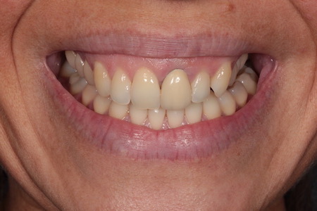 Before Smile Makeover Treatment Reading Smiles Before Smile Makeover Treatment Reading Smiles