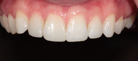 uneven-Composite-Bonding-a-1 After Invisalign Treatment Reading Smiles
