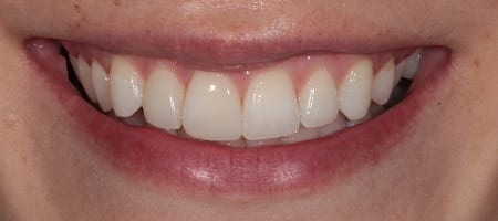 uneven-Composite-Bonding-a After Invisalign Treatment Reading Smiles