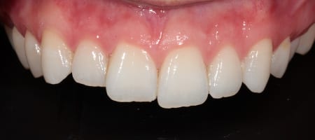 uneven-Composite-Bonding-b-1 Before & after cosmetic bonding