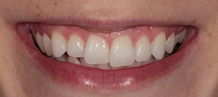 uneven-Composite-Bonding-b Before & after cosmetic bonding