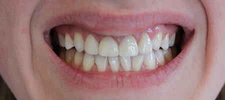 After Veneers Treatment Reading Smiles After Veneers Treatment Reading Smiles