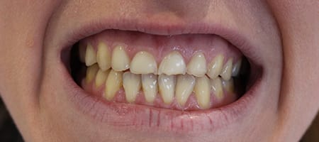 Before veneers Treatment Reading Smiles Before veneers Treatment Reading Smiles