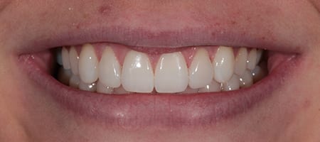 yellow teeth - tooth whitening and composite bonding-a After Invisalign Treatment Reading Smiles
