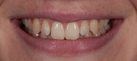 yellow teeth - tooth whitening and composite bonding-b Before & after cosmetic bonding
